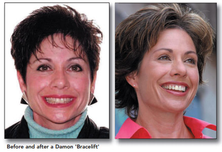 The 'Bracelift' Facelift