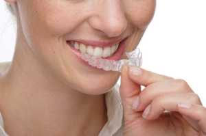 Invisalign for adults